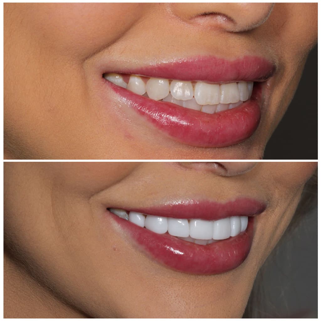 smiling-dental-porcelain-veneers-before-after-8-1024x1024-10-compress